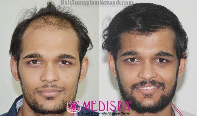 Front view - Before and after hair restoration procedure