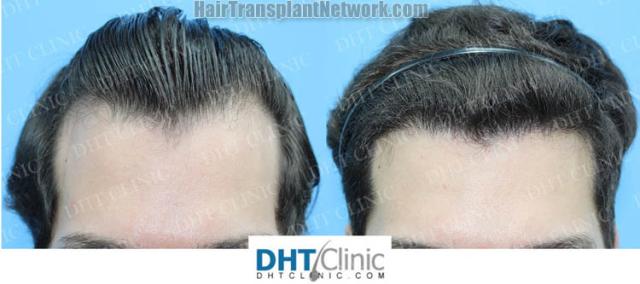 Front view - Before and after hair restoration procedure