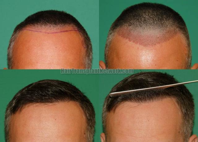  Before and after hair restoration procedure