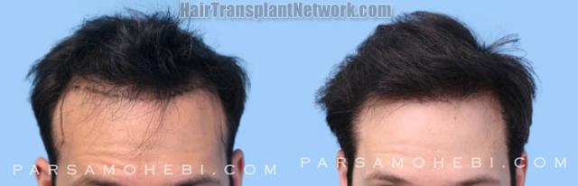 Front view - Before and after hair restoration procedure