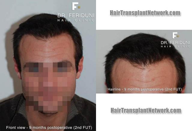 Hair restoration surgery before and after photos