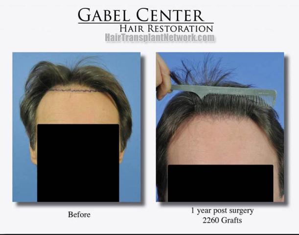 Before and after hair transplant procedure images