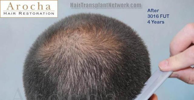 Back view four year postoperative from hair transplant