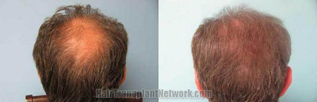 Back view before and after hair transplantation photos