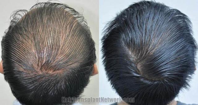 Hair restoration procedure before and after pictures