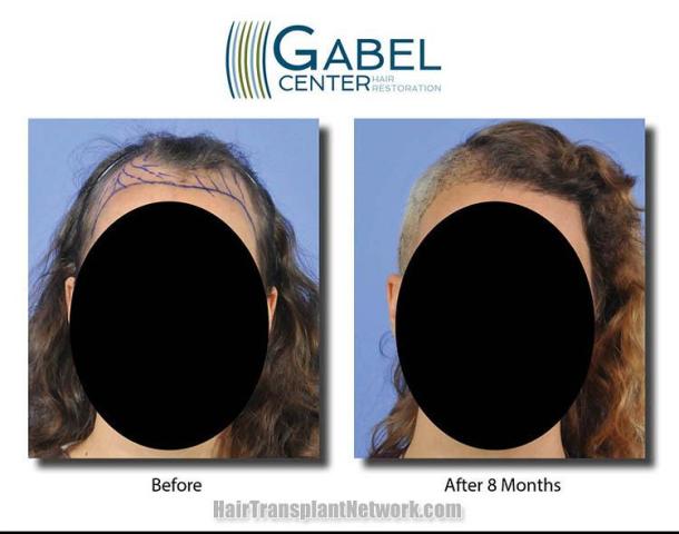 Hair transplantation surgery before and after images