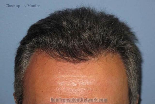 Hair restoration surgery before and after photos