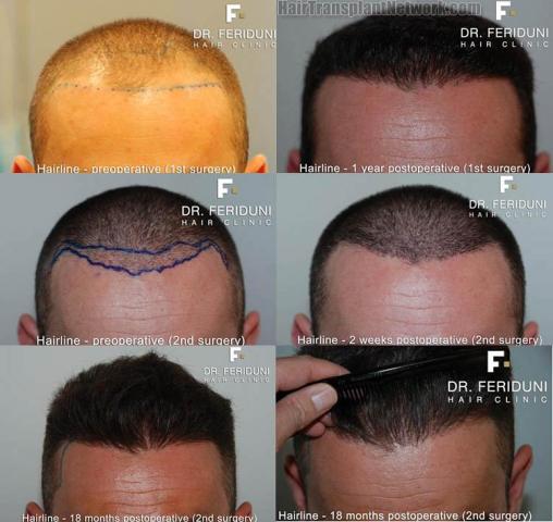 Hair restoration procedure before and after results