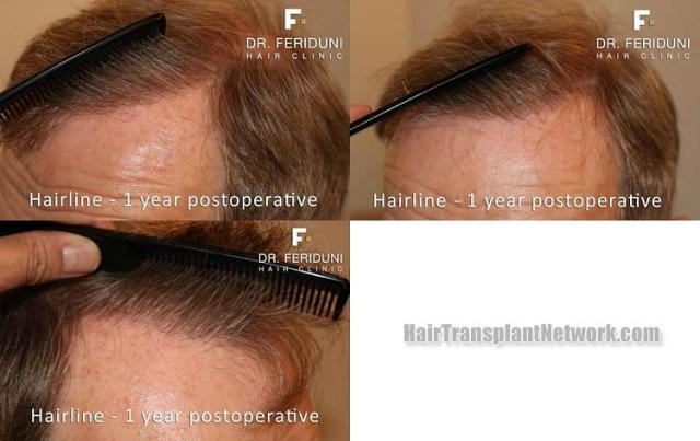 Hair restoration surgery after photos