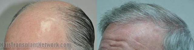 Hair transplantation surgery before and after pictures