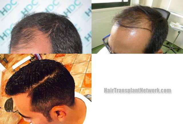 Hair transplantation surgery before and after pictures