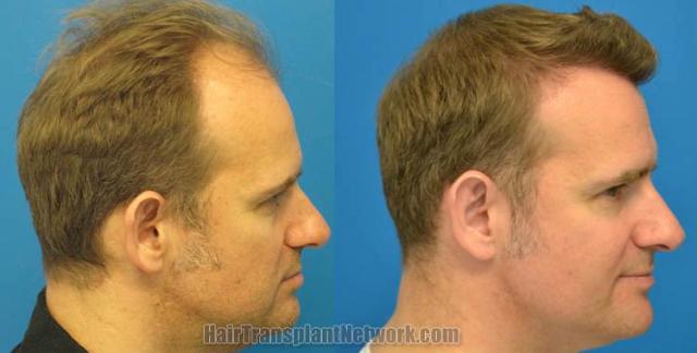 Hair transplantation surgery before and after images