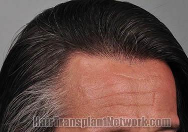 Hair transplantation surgery before and after photos