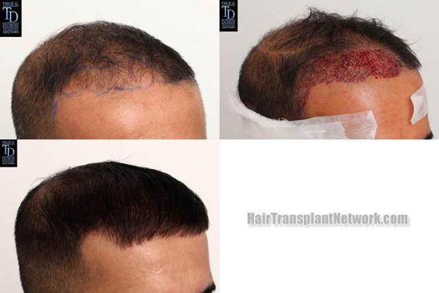 Hair transplantation surgery before and after photos