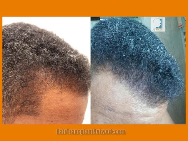 Hair transplantation surgery before and after photos