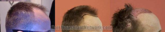 Hair transplantation surgery before and after photos