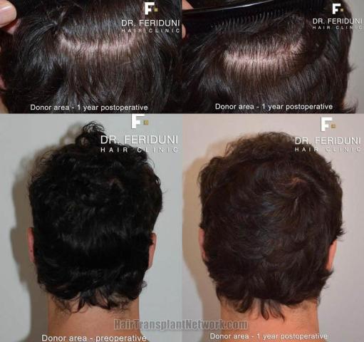 Hair transplantation surgery before and after pictures