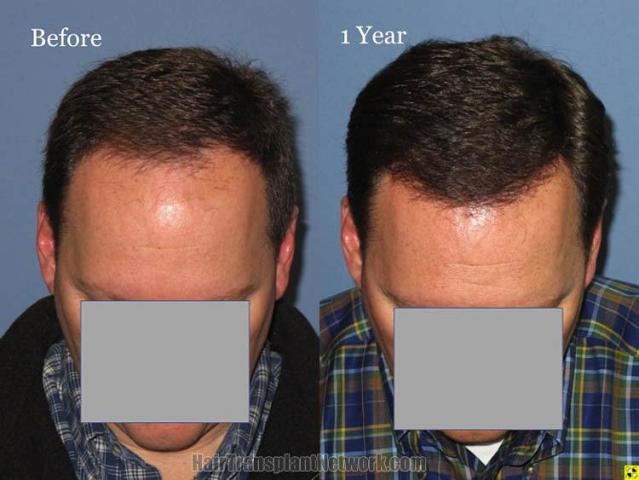 Before and after hair transplantation result photographs