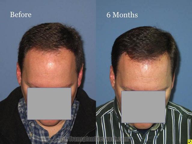 Hair transplantation surgery before and after photos