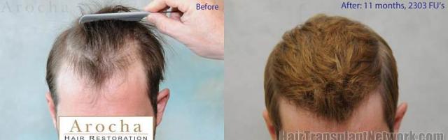 Hair transplantation surgery before and after images