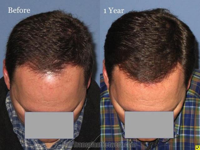 Top view - Before and after surgical hair replacement