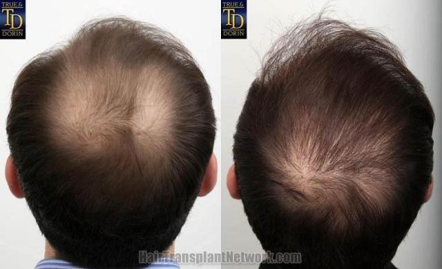 Hair restoration procedure before and after pictures