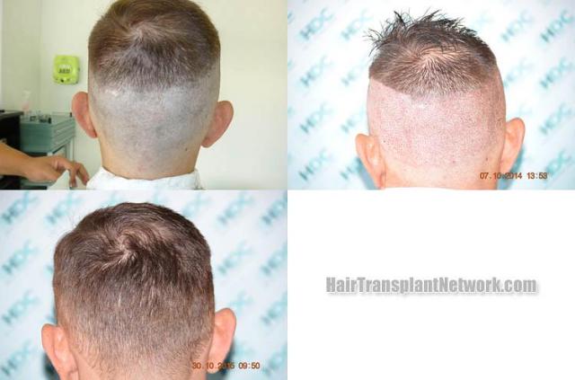 Hair transplantation surgery before and after pictures