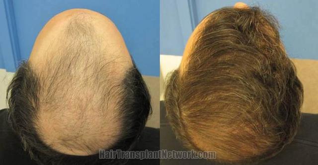 Crown / Top view before and after hair replacement procedure