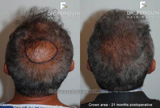 Hair restoration procedure before and after pictures