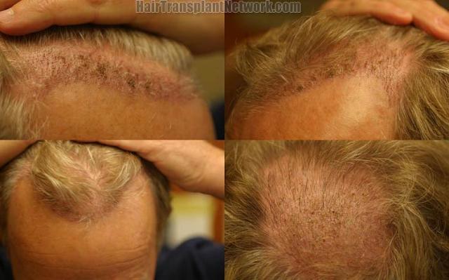 Hair restoration surgery before and after photos