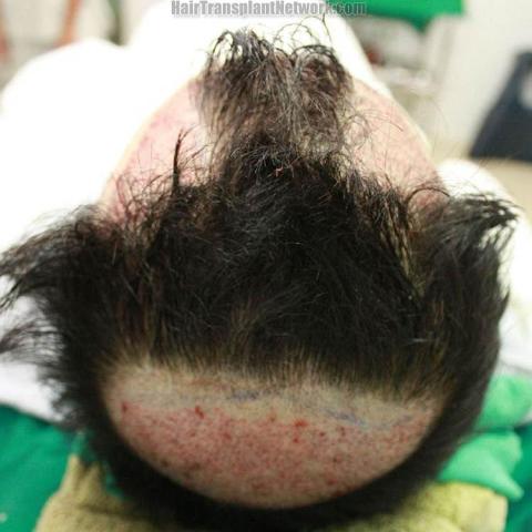 Hair transplant surgery before and after photos