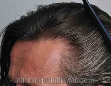 Hair transplantation surgery before and after images