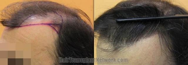 Hair transplantation surgery before and after images