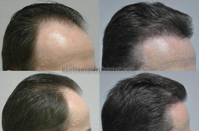 Hair transplantation surgery before and after images