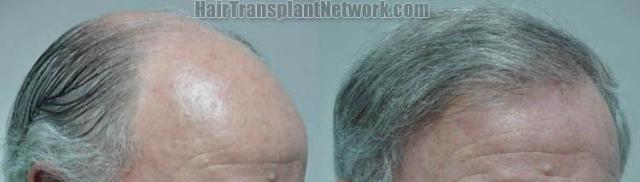 Hair transplantation surgery before and after images