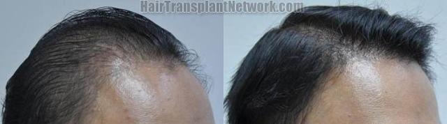 Hair transplantation surgery before and after images