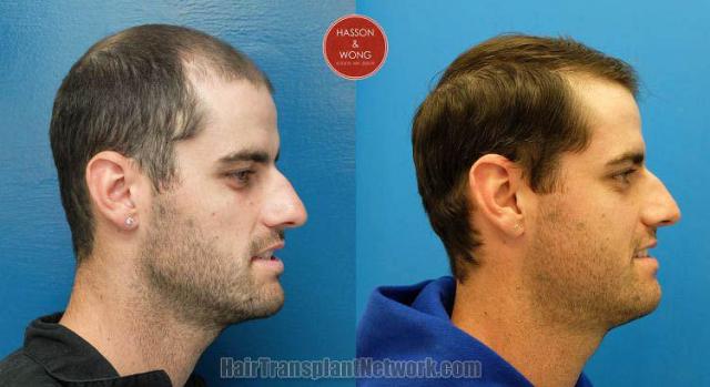 Hair restoration procedure before and after results