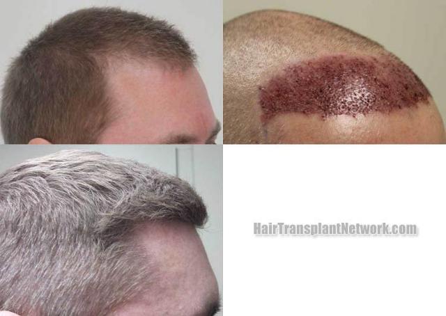 Hair restoration procedure before and after pictures