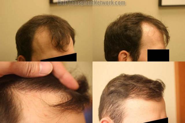 Hair restoration procedure before and after pictures