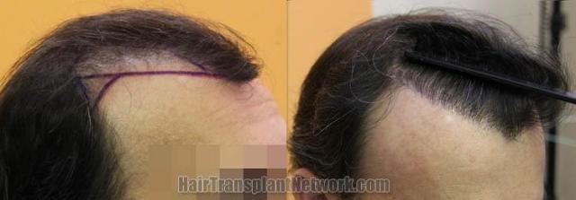 Hair restoration procedure before and after pictures