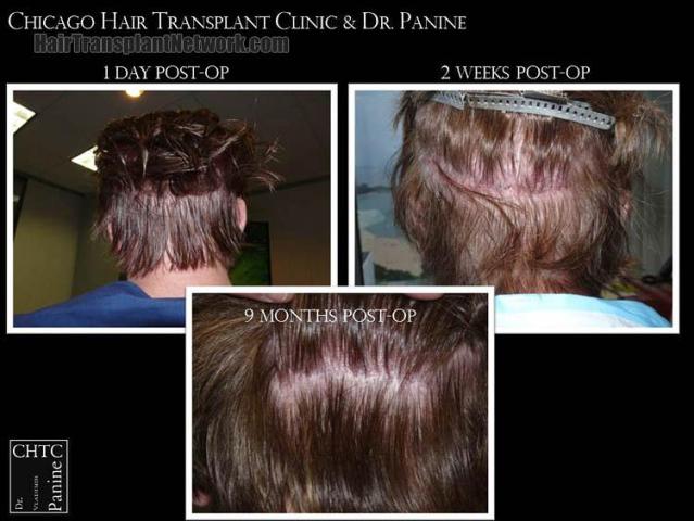 Hair transplantation surgery before and after pictures