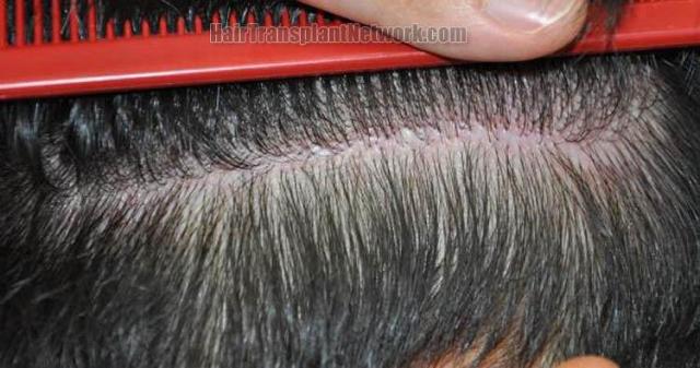 Hair transplant surgery before and after photos