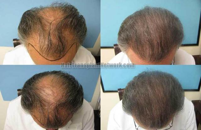 Top view - Before and after surgical hair replacement