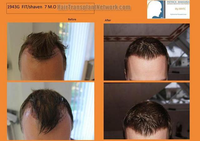 Top view - Before and after surgical hair replacement