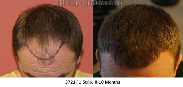 Hair restoration procedure before and after results