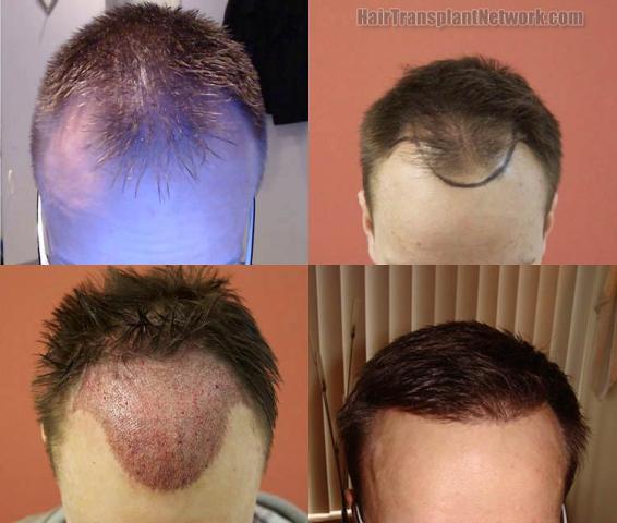 Top view before and after hair restoration results