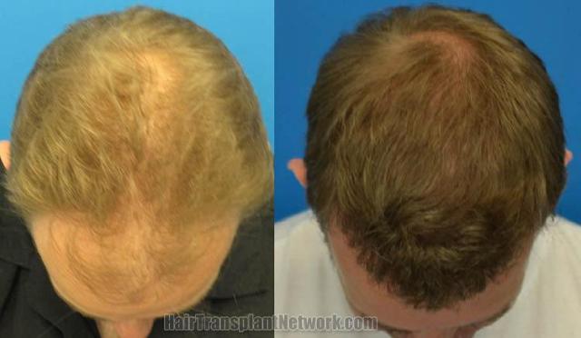 Hair transplantation surgery before and after photos