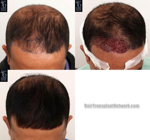 Hair restoration procedure before and after results