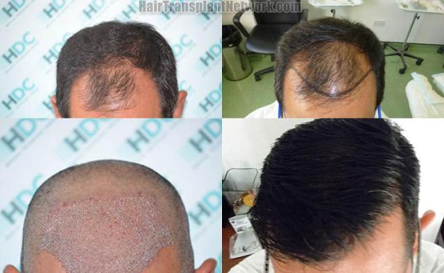 Hair transplantation surgery before and after images