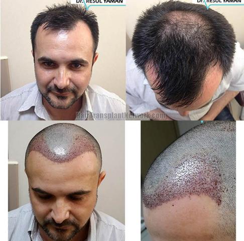 Hair restoration surgery after photos